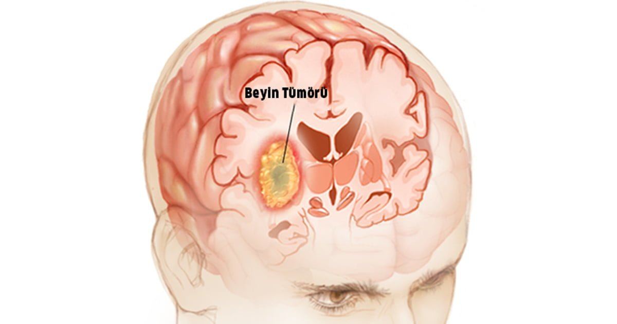 Проблемы с головным мозгом симптомы. Злокачественная глиома. Объемное образование головного мозга.